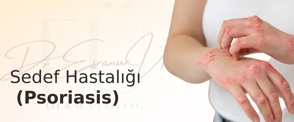 Psoriazis (Sedef Hastalığı)